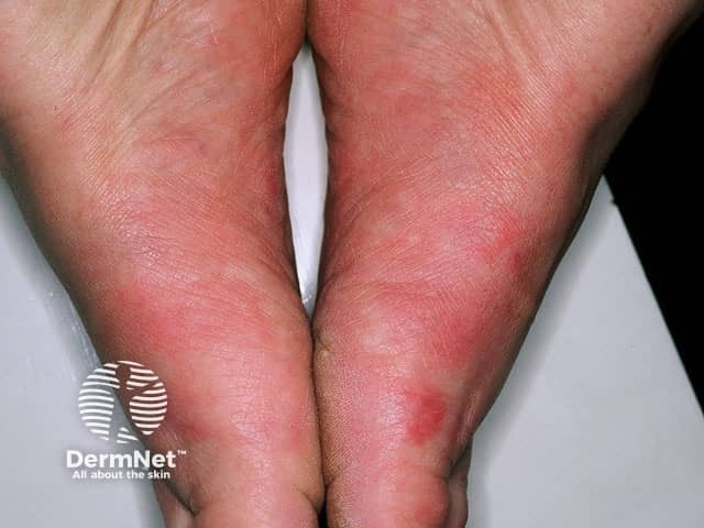 Idiopathic plantar hidradenitis