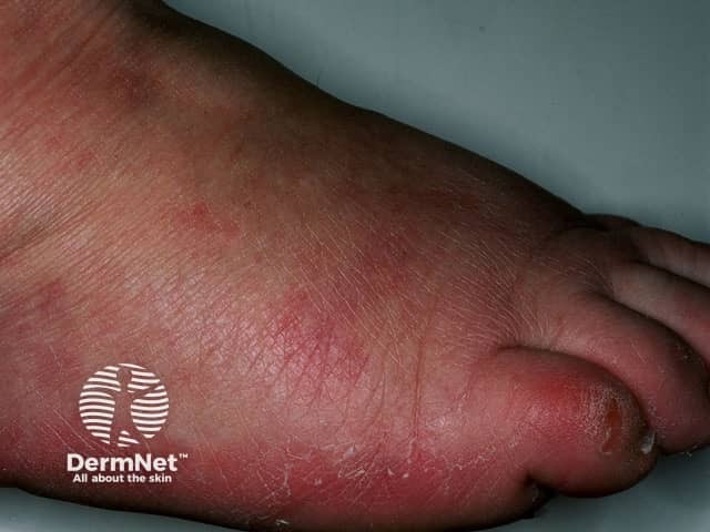 Idiopathic plantar hidradenitis