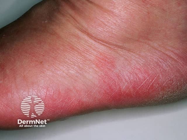 Idiopathic plantar hidradenitis