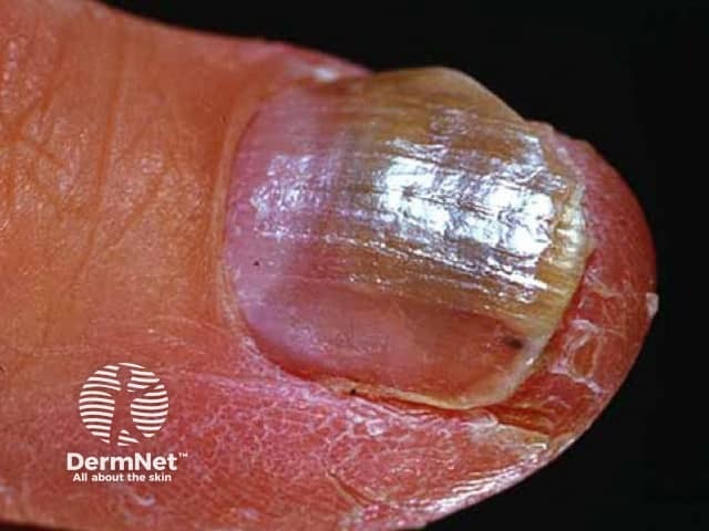 Fungal nail infection