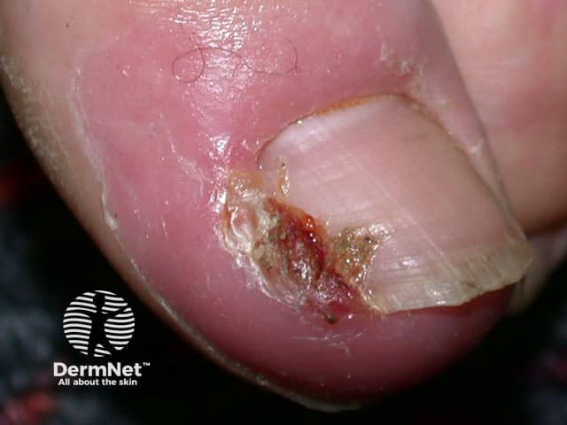 Ingrown toenail