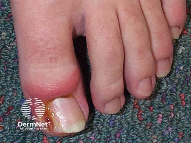 In-growing nail with granuloma formation aggravated by an oral retinoid