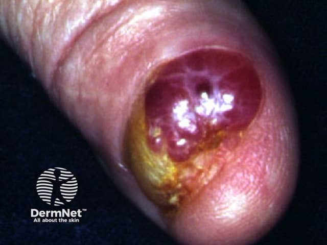 Subungual melanoma