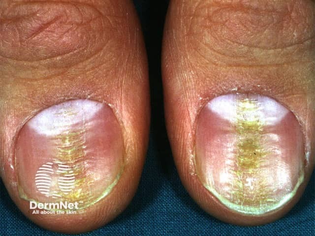 Median canaliform nail dystrophy