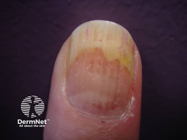 Psoriatic nail dystrophy