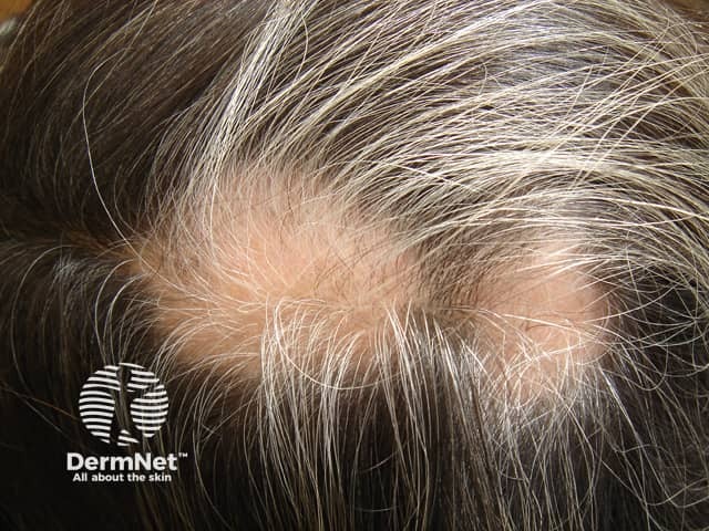 Poliosis in alopecia areata