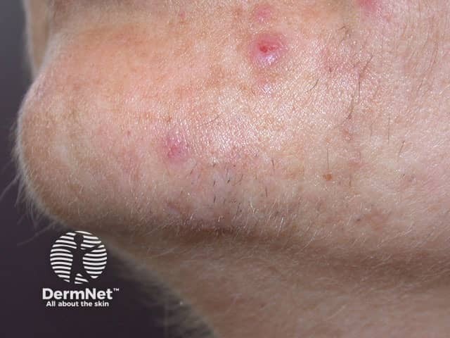 Folliculitis due to hair removal