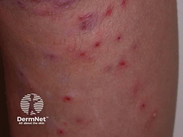 Folliculitis due to hair removal