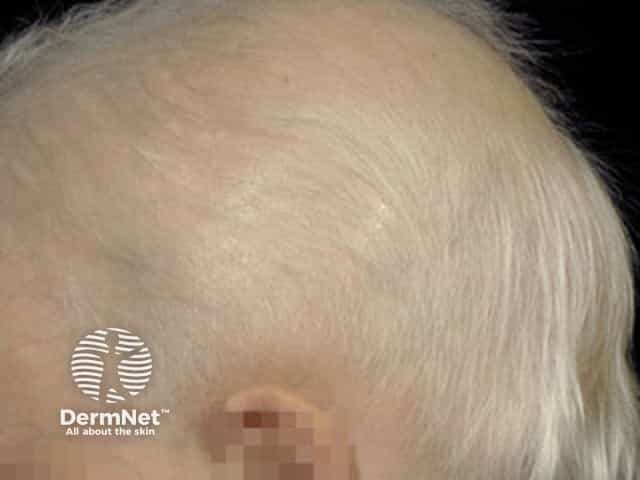 Anhidrotic ectodermal dysplasia