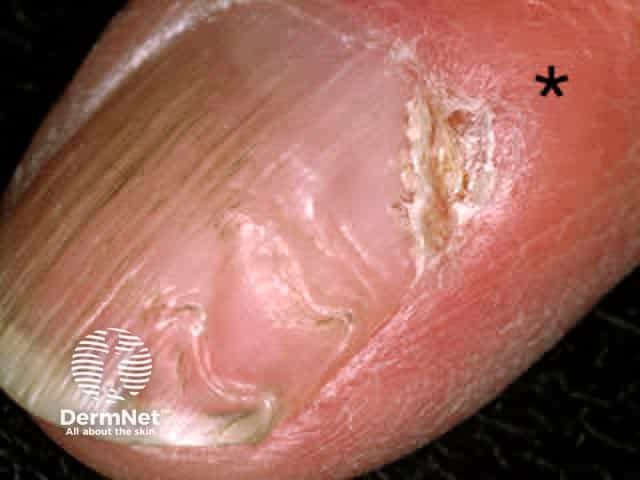 Myxoid cyst