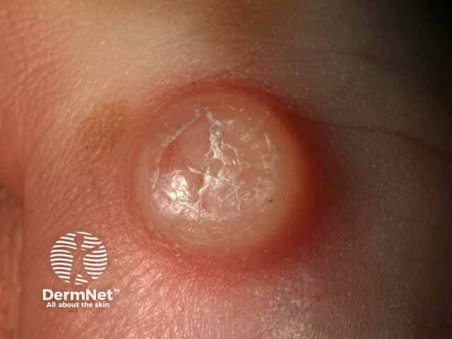 Myxoid cyst