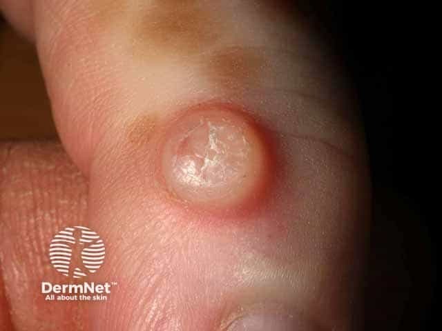 Myxoid cyst