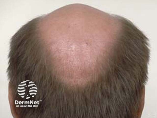 Pattern balding