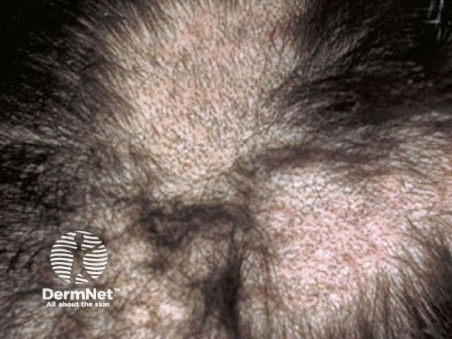 Trichotillomania