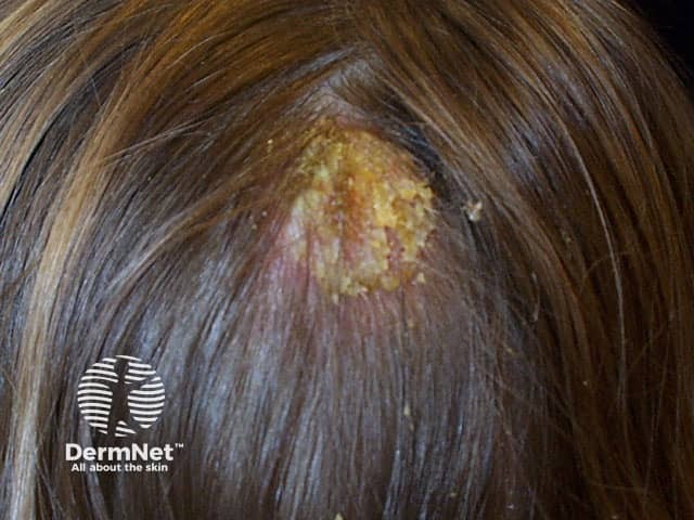 Seborrhoeic dermatitis