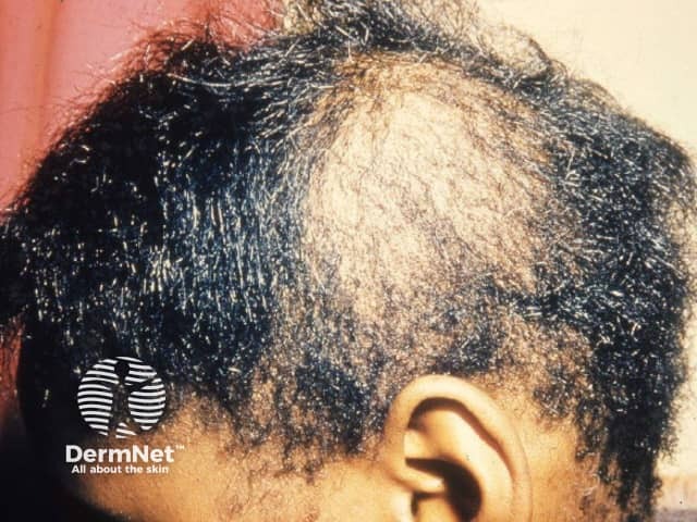 Traction alopecia