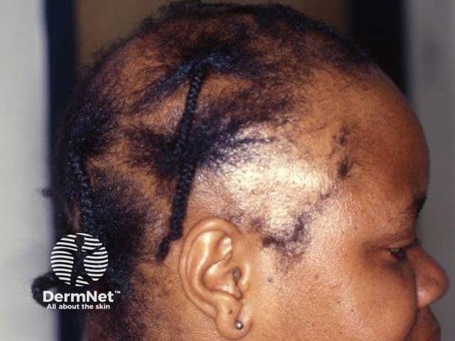 Traction alopecia