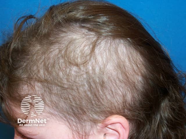 Trichotillomania