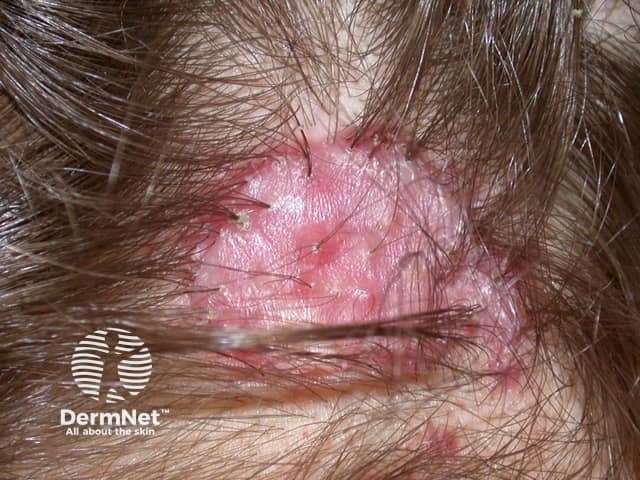 Tufted folliculitis