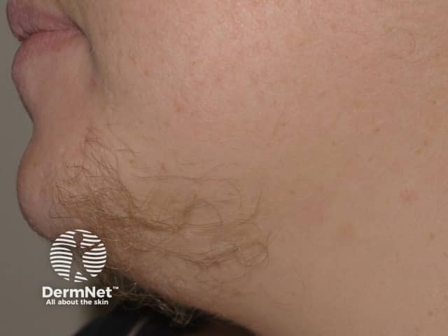 Facial hirsutism