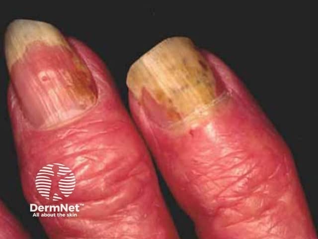 Nail psoriasis