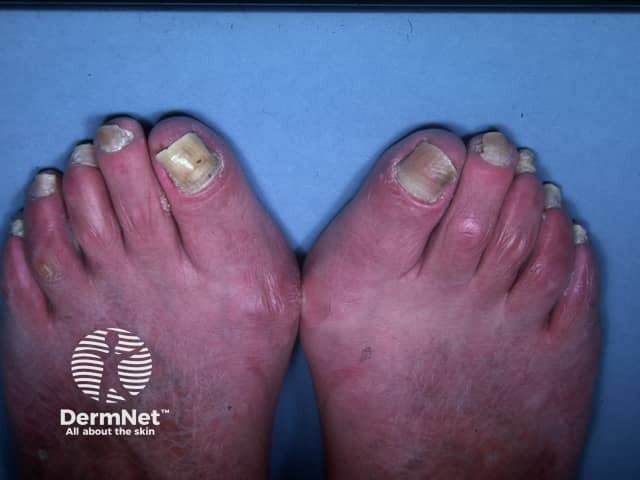 Yellow nail syndrome