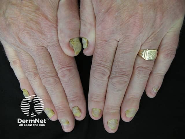 Yellow nail syndrome