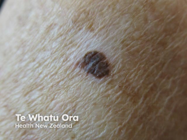 Melanoma with depigmentation