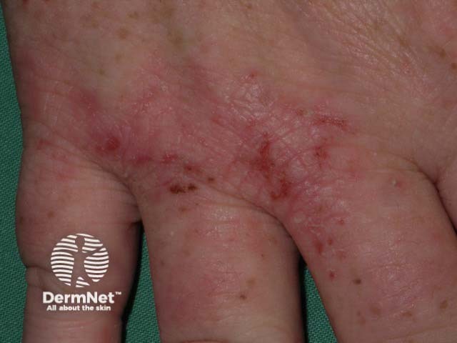 Hand dermatitis