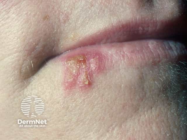 Herpes simplex labialis