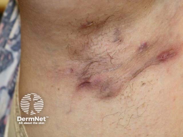 Hidradenitis suppurativa