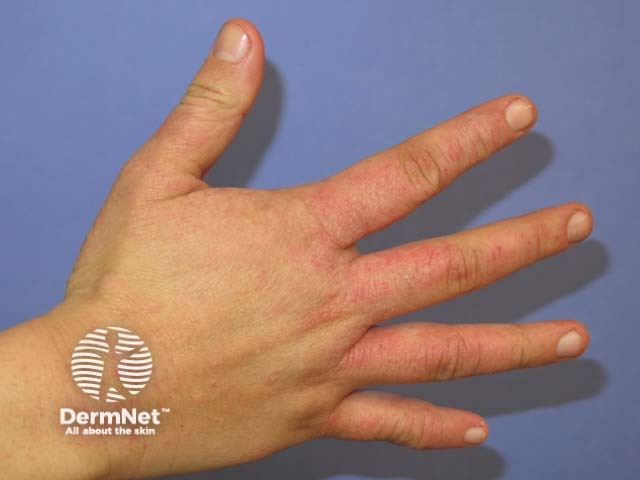 Irritant contact dermatitis