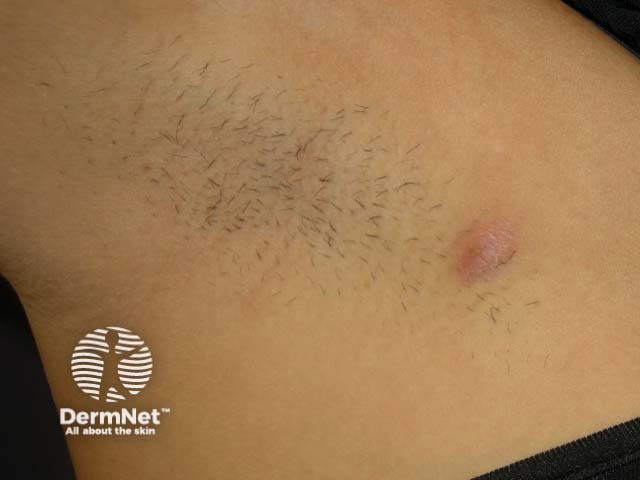 Hurley Stage I hidradenitis suppurativa