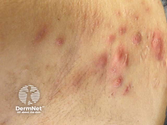 Regular hidradenitis suppurativa