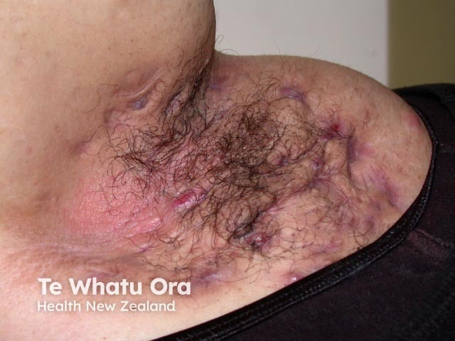 Hidradenitis suppurativa of axilla