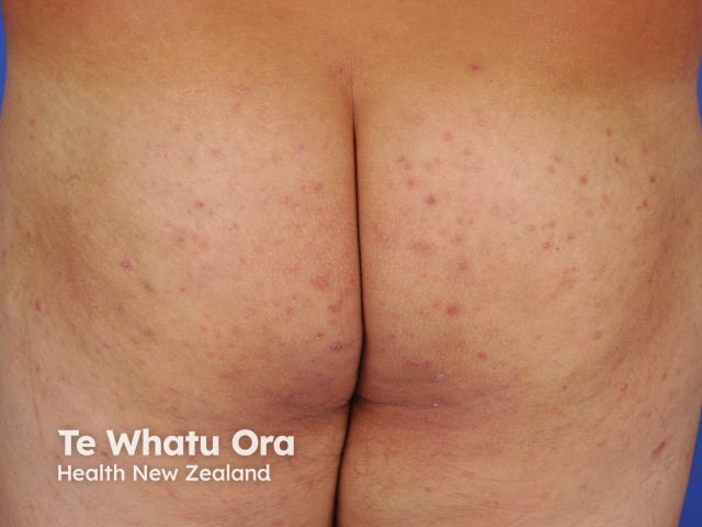 Hidradenitis suppurativa of buttocks