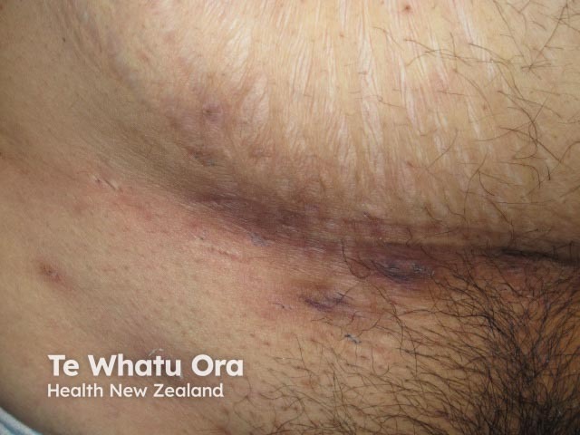 Hidradenitis suppurativa of groin