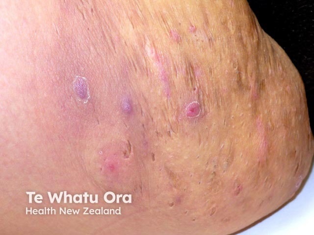 Hidradenitis suppurativa of groin