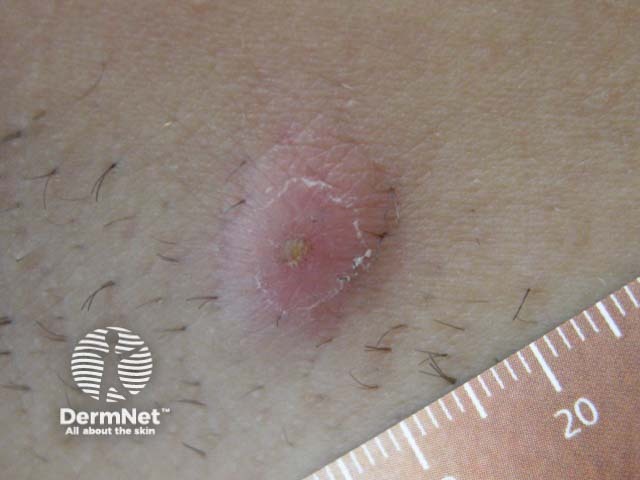 Inflammatory lesion in hidradenitis suppurativa