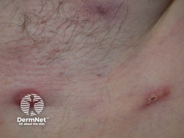 Inflammatory lesion in hidradenitis suppurativa