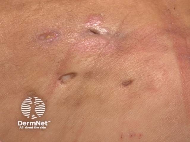 Scarring in hidradenitis suppurativa