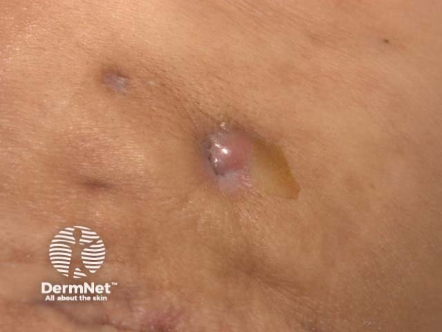 Scarring in hidradenitis suppurativa