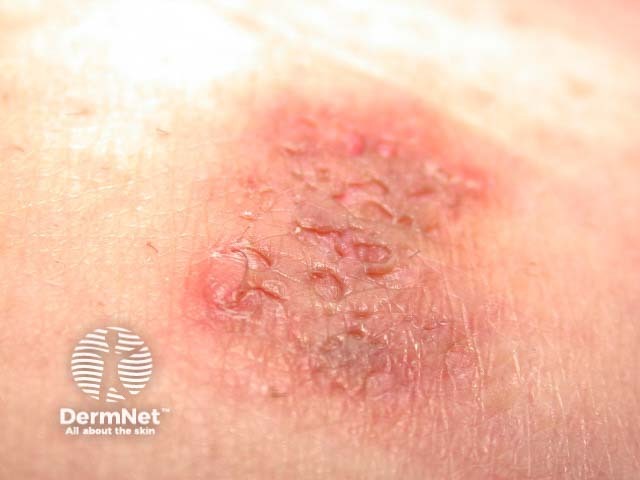 Scarring in hidradenitis suppurativa