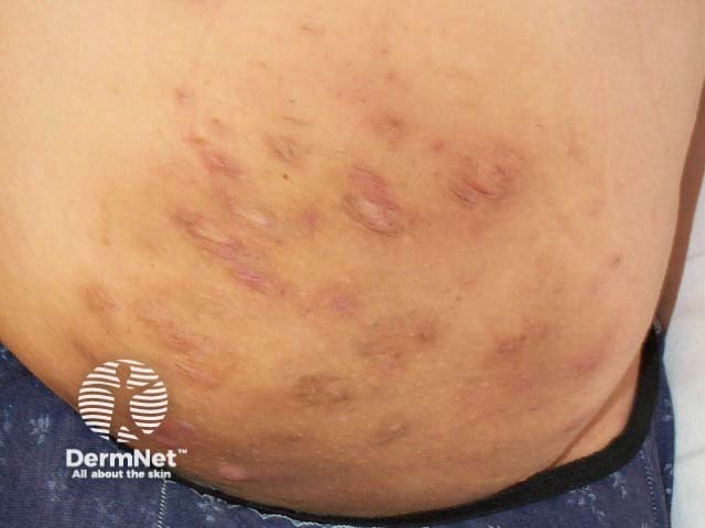 Scarring in hidradenitis suppurativa