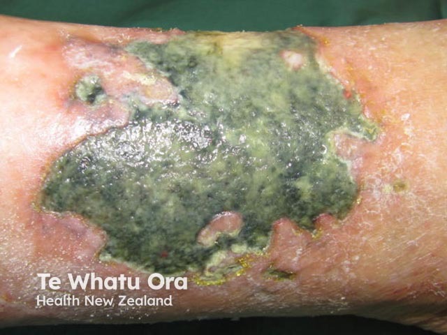 Hydroxyurea-induced leg ulcer