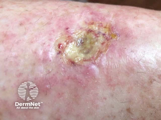 Hydroxyurea-induced leg ulcer