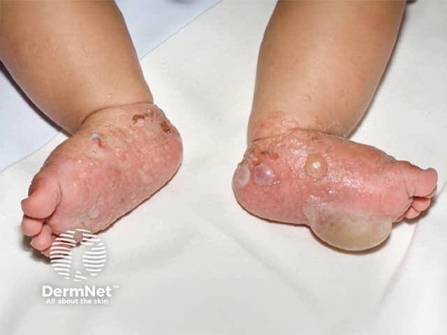 Childhood bullous pemphigoid