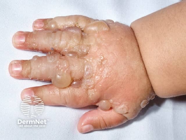 Childhood bullous pemphigoid