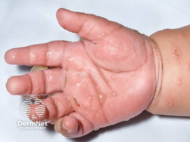 Childhood bullous pemphigoid