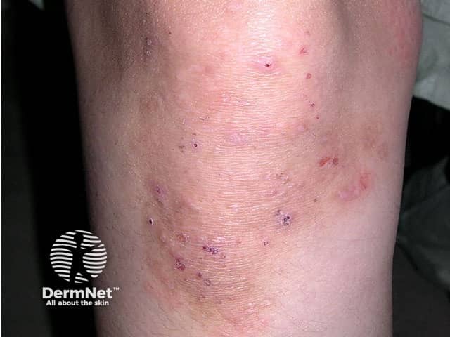 Dermatitis herpetiformis